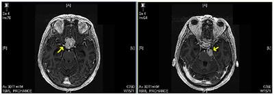 Optic nerve and chiasm hemangioblastomas in von Hippel-Lindau disease: report of 12 cases and review of the literature